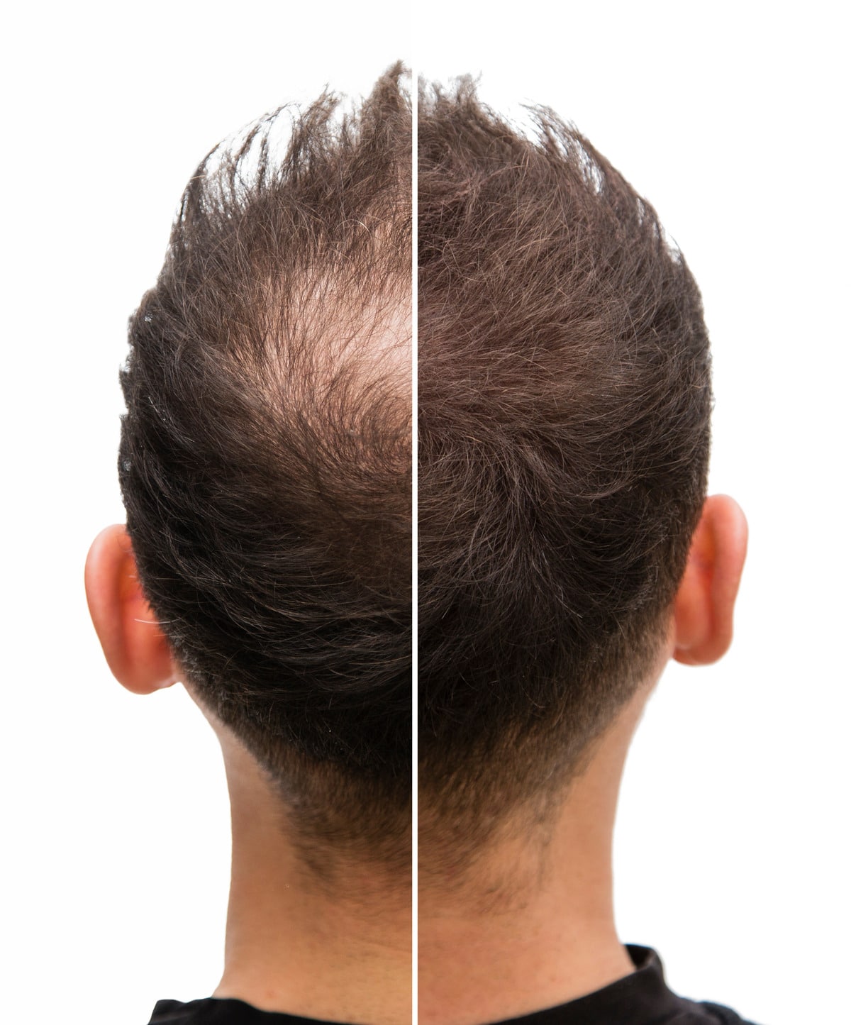 Hair Transplant UK – Natural Looking Results You Can Trust